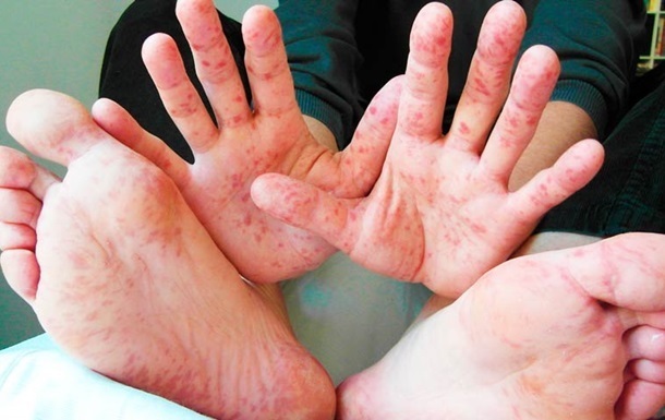 В Україні у 20 разів зросла кількість випадків захворювання на кір