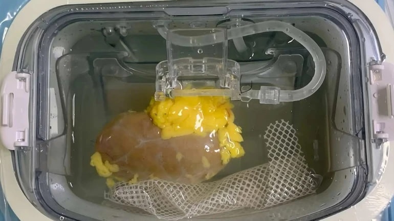 Науковці вперше створили “універсальну” нирку для трансплантації