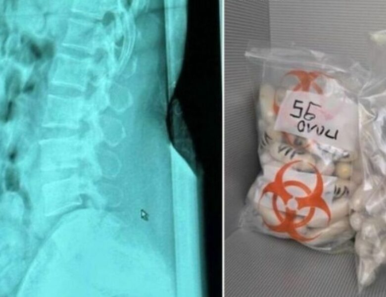 В Італії затримано жінку з 1,4 кг героїну в шлунку