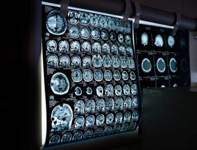 Два роки невідомої хвороби: у жінки діагностували пухлину мозку