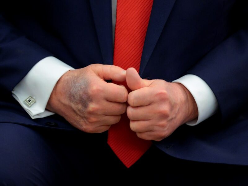 Повторні синці на руці: у США обговорюють здоров’я Трампа